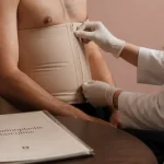 Abdominoplastie homme : gaine de compression sur toile de consultation médicale