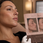 Lifting visage avant après, résultat naturel après 3 mois