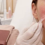Couperose disparue : application laser sur rougeurs et couperose